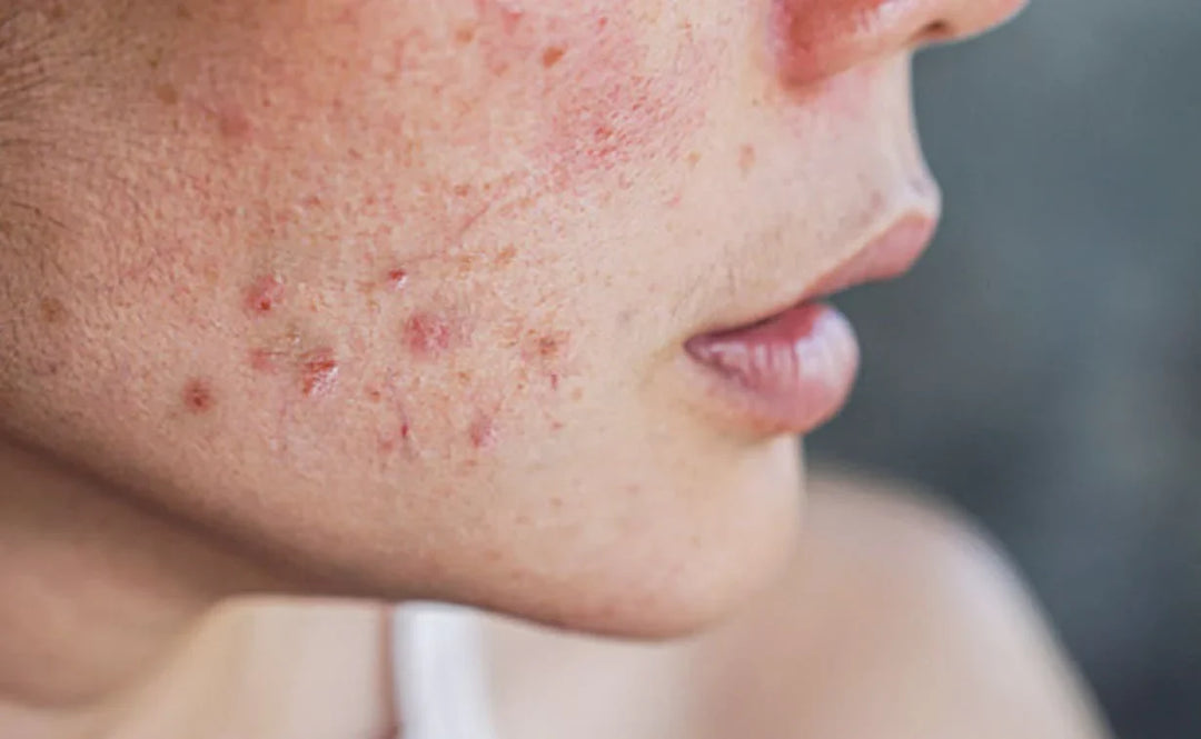 Acne, Hair Loss & Hair Growth